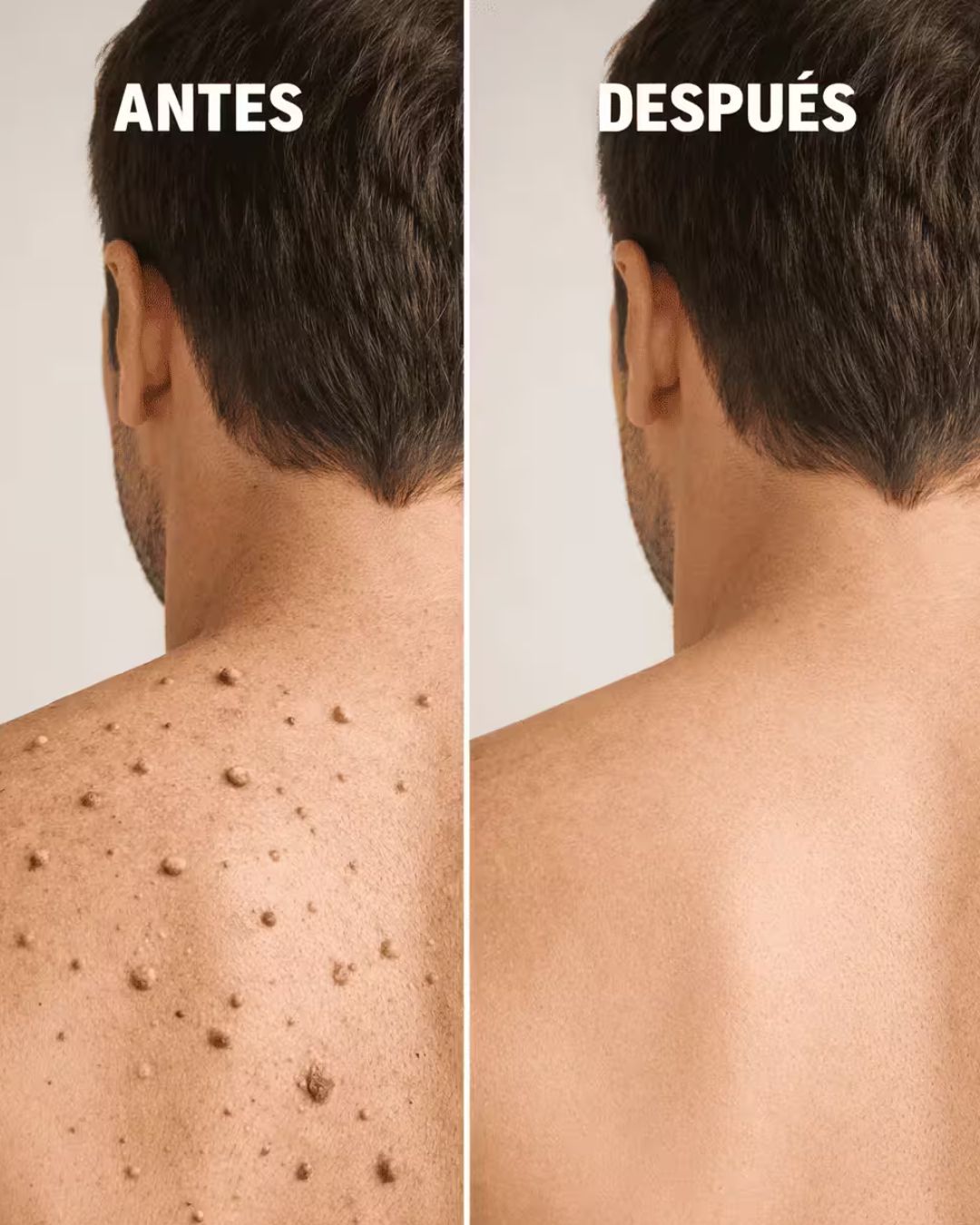 Tag Recede™- Spray eliminador de verrugas