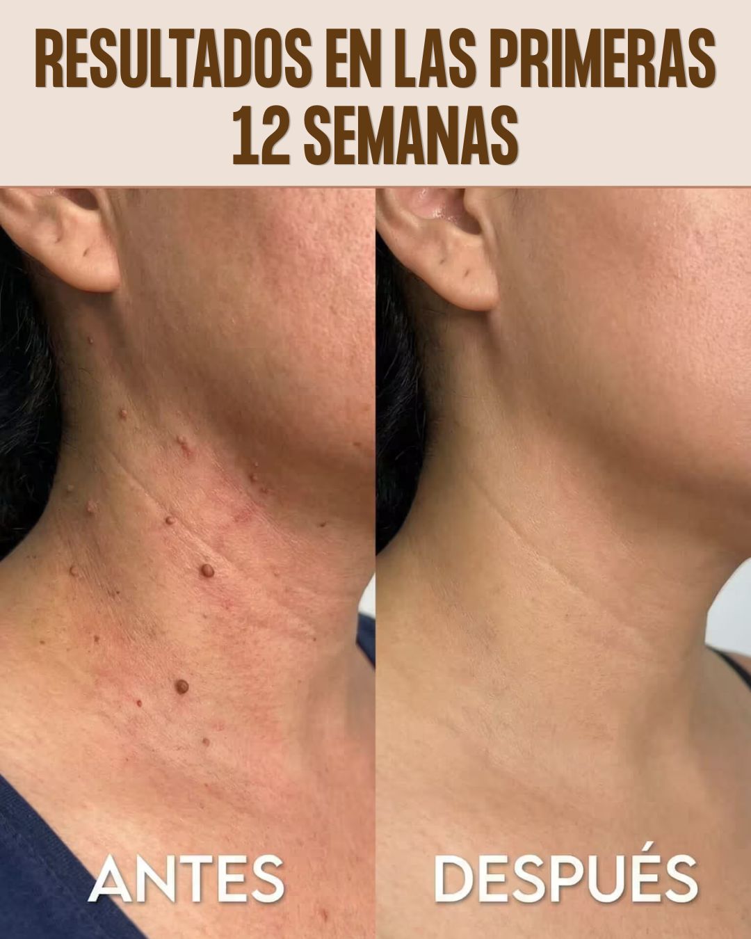 Tag Recede™- Spray eliminador de verrugas